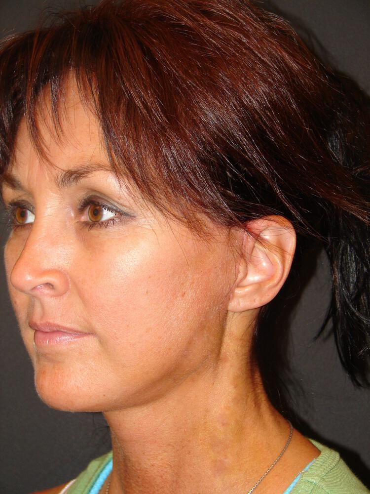 Deep Plane Facelift (Contour Lift) Before & After Image