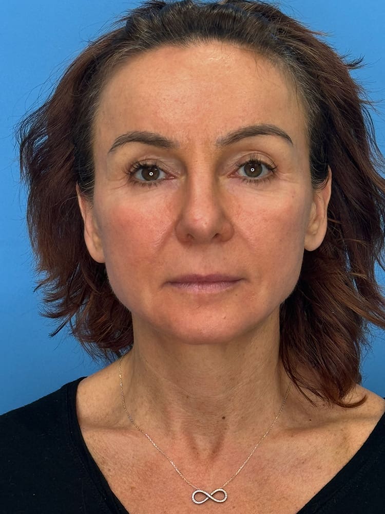 Deep Plane Facelift (Contour Lift) Before & After Image