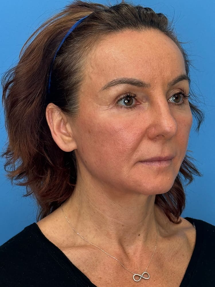 Deep Plane Facelift (Contour Lift) Before & After Image