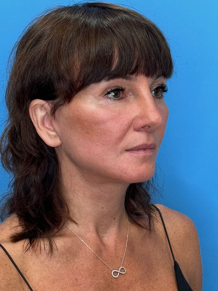 Deep Plane Facelift (Contour Lift) Before & After Image