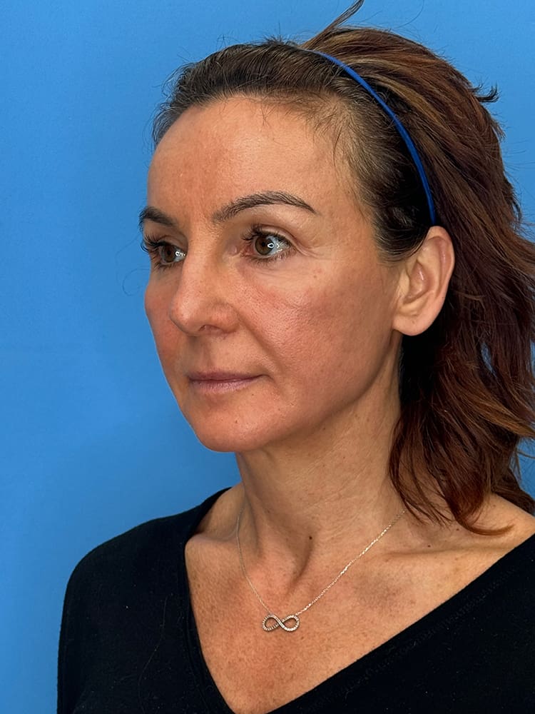 Deep Plane Facelift (Contour Lift) Before & After Image