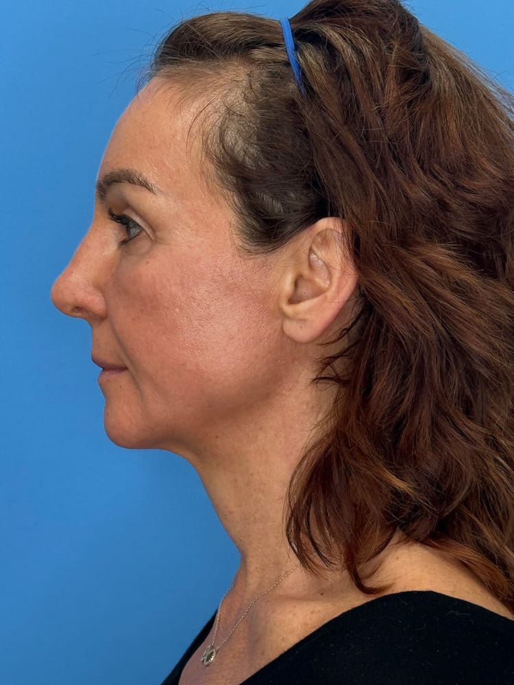 Deep Plane Facelift (Contour Lift) Before & After Image