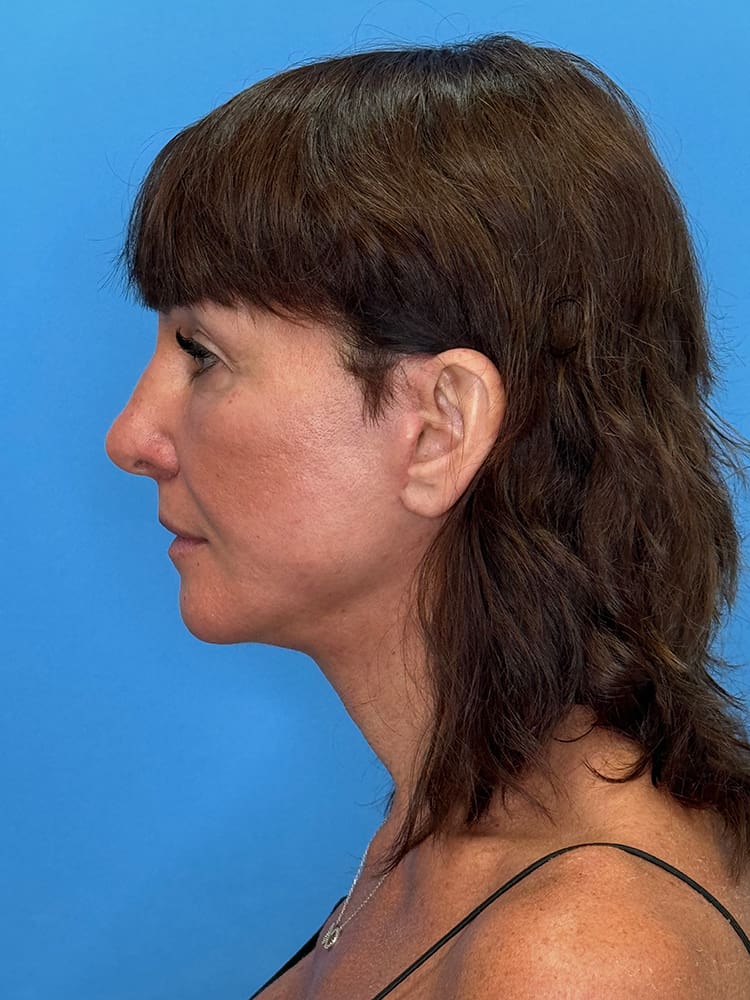 Deep Plane Facelift (Contour Lift) Before & After Image