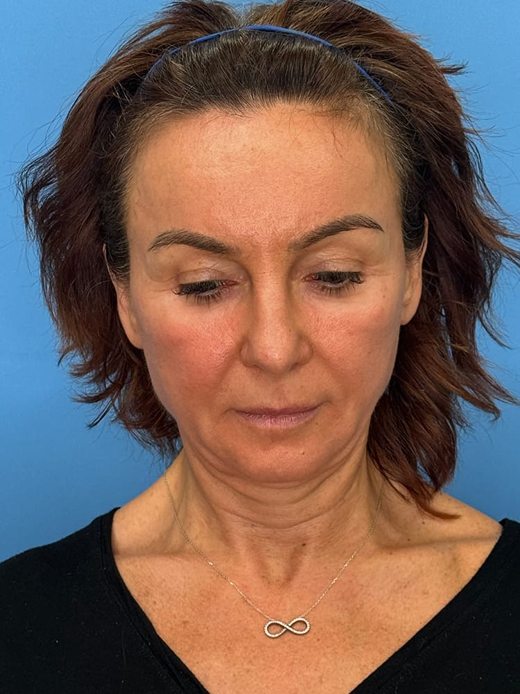 Deep Plane Facelift (Contour Lift) Before & After Image