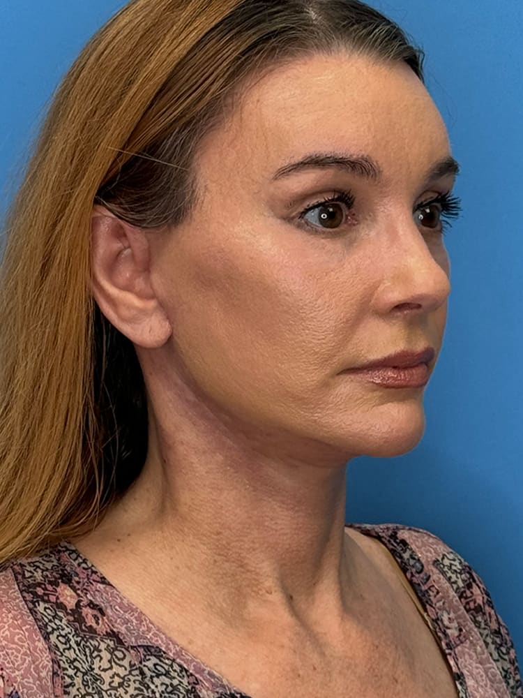 Deep Plane Facelift (Contour Lift) Before & After Image