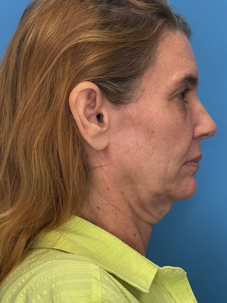 Deep Plane Facelift (Contour Lift) Before & After Image