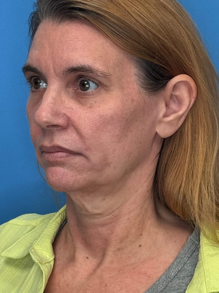 Deep Plane Facelift (Contour Lift) Before & After Image