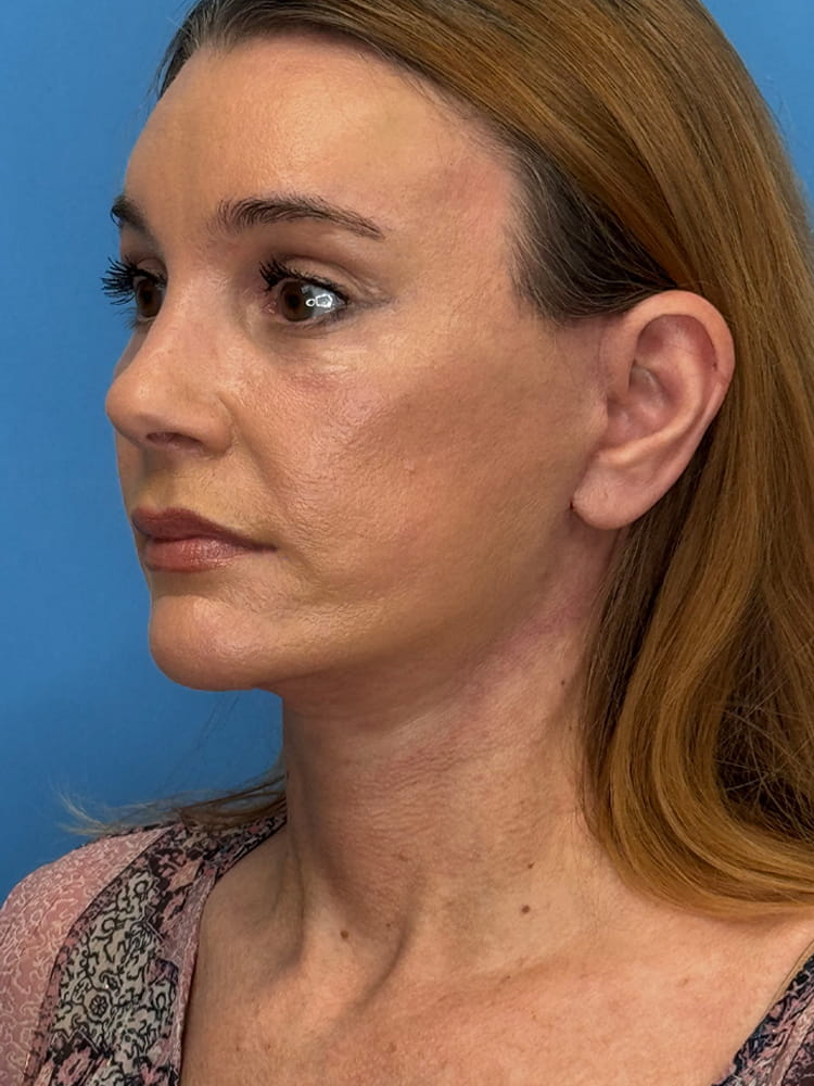 Deep Plane Facelift (Contour Lift) Before & After Image