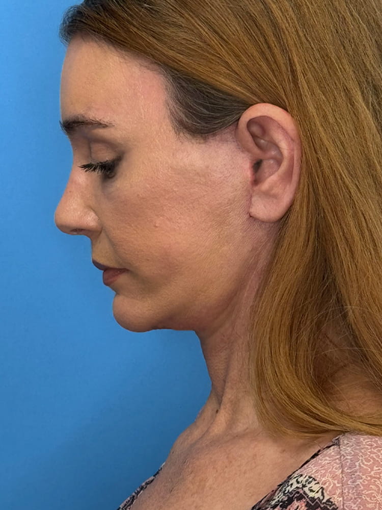 Deep Plane Facelift (Contour Lift) Before & After Image