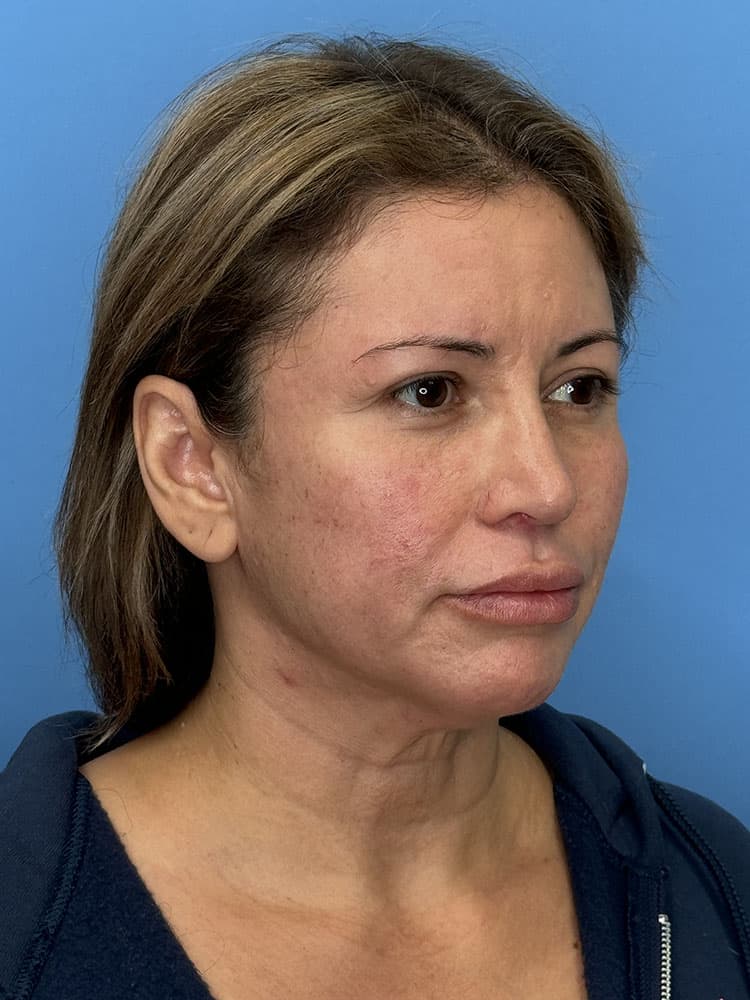 Deep Plane Facelift (Contour Lift) Before & After Image