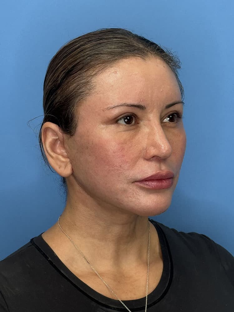 Deep Plane Facelift (Contour Lift) Before & After Image