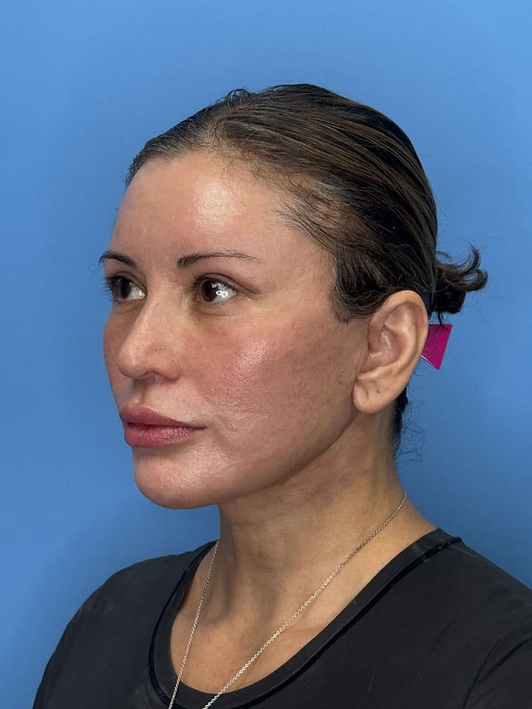 Deep Plane Facelift (Contour Lift) Before & After Image