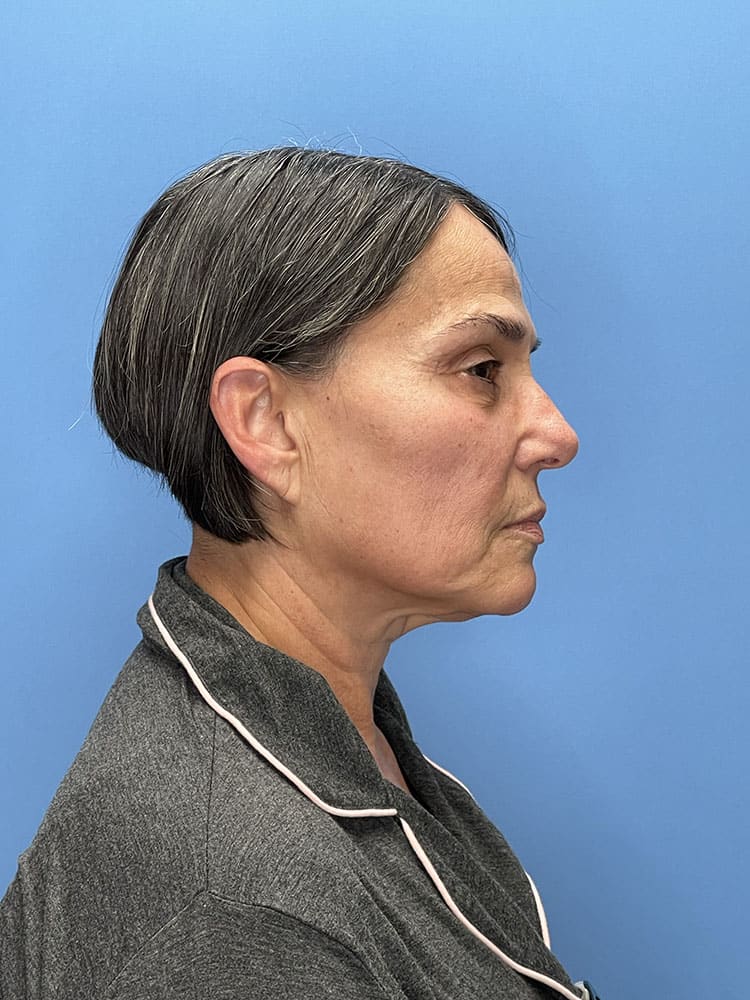 Facelift Before & After Image