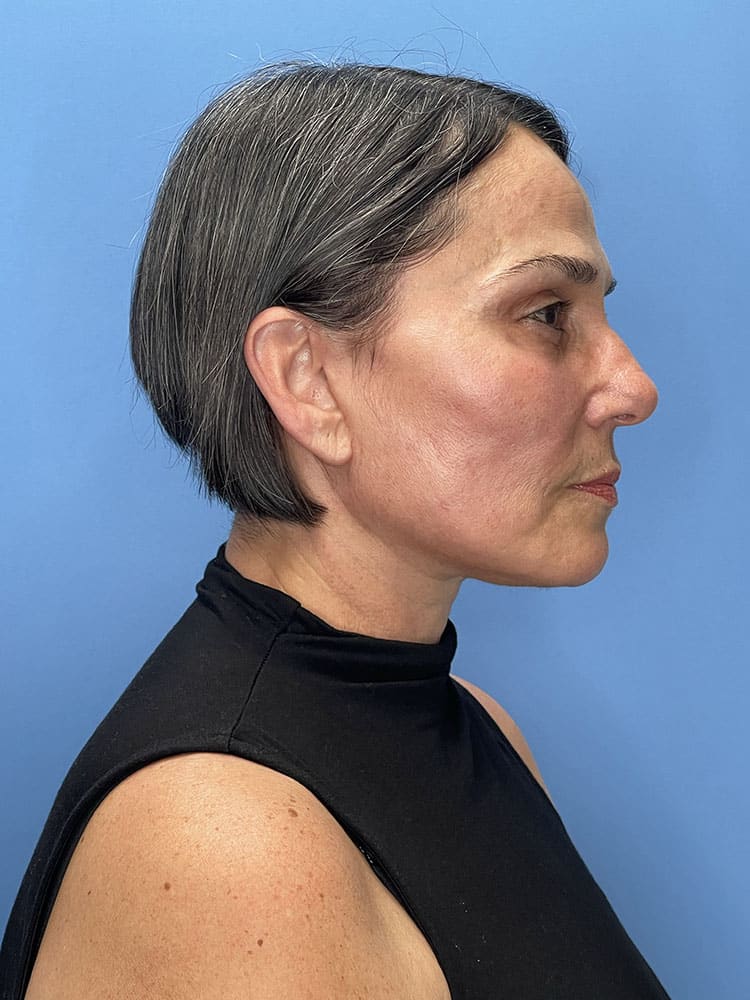 Facelift Before & After Image