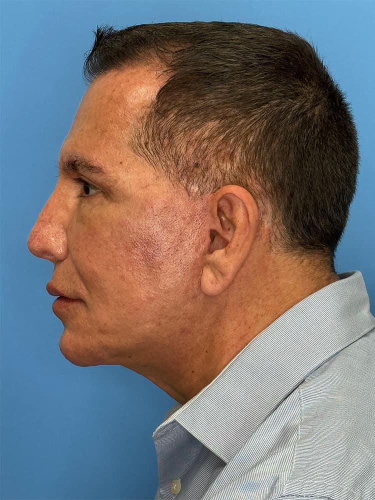 Facelift Before & After Image