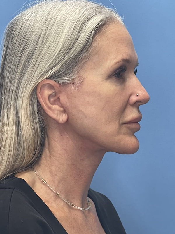 Facelift Before & After Image