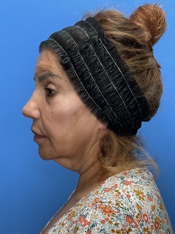 Facial Fat Grafting Before & After Image