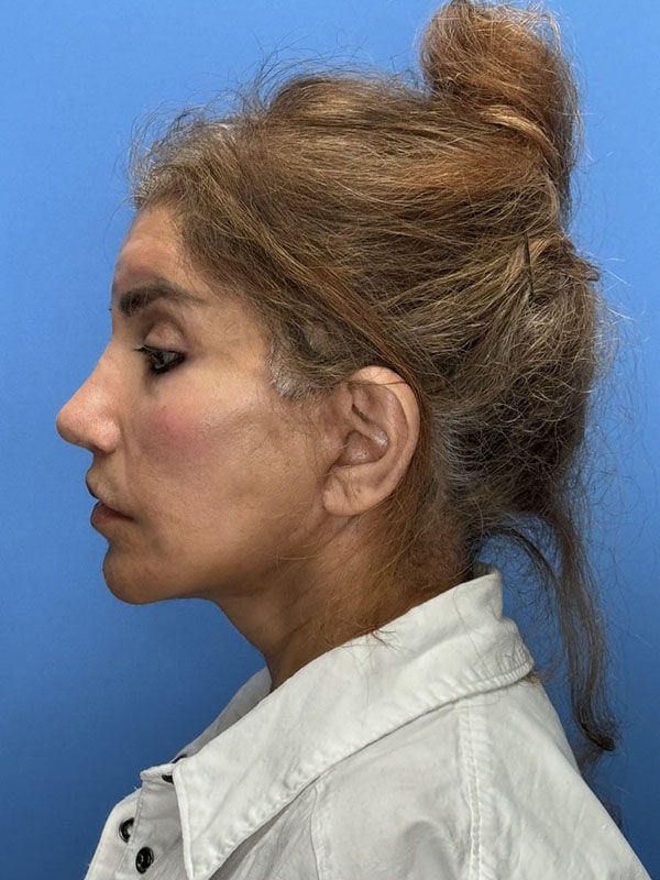 Facial Fat Grafting Before & After Image