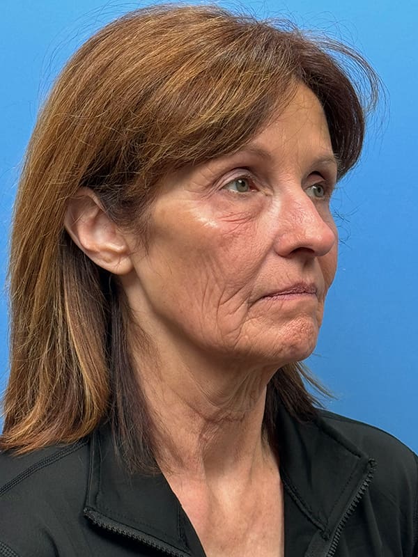 Lower Facelift<br>(SMAS Lift) Before & After Image