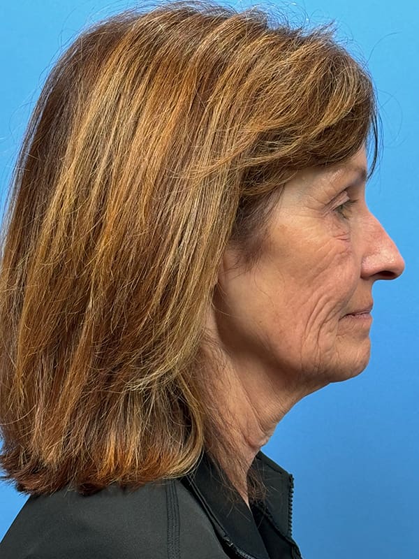 Lower Facelift<br>(SMAS Lift) Before & After Image