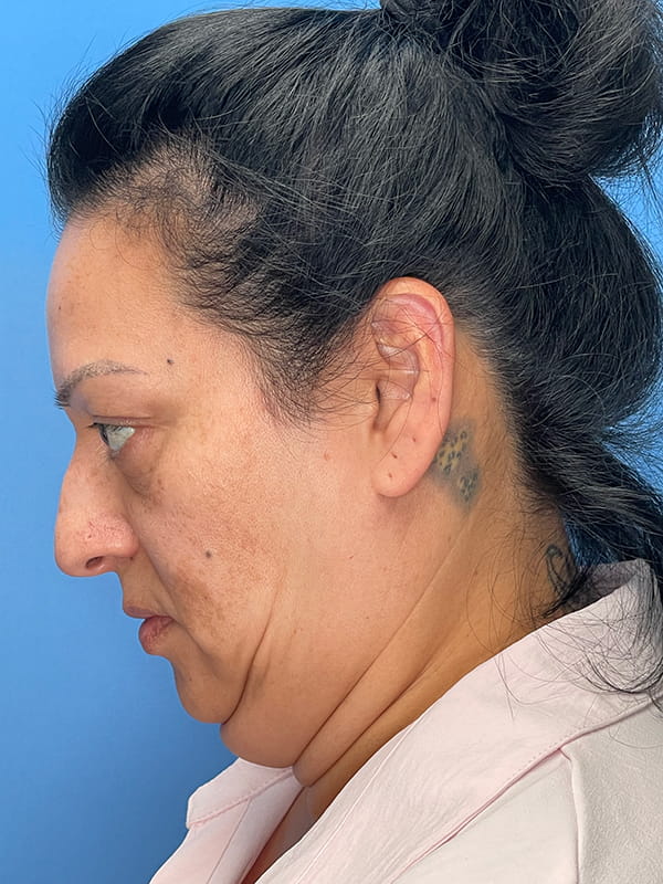 Lower Facelift (SMAS Lift) Before and After | OCSS