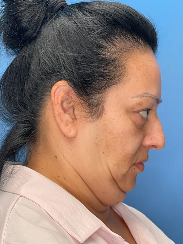 Lower Facelift<br>(SMAS Lift) Before & After Image