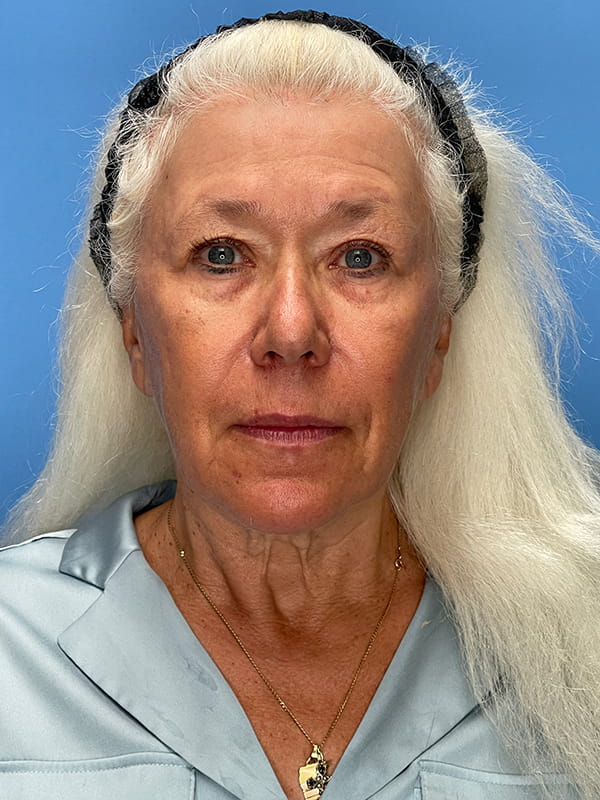 Lower Facelift<br>(SMAS Lift) Before & After Image