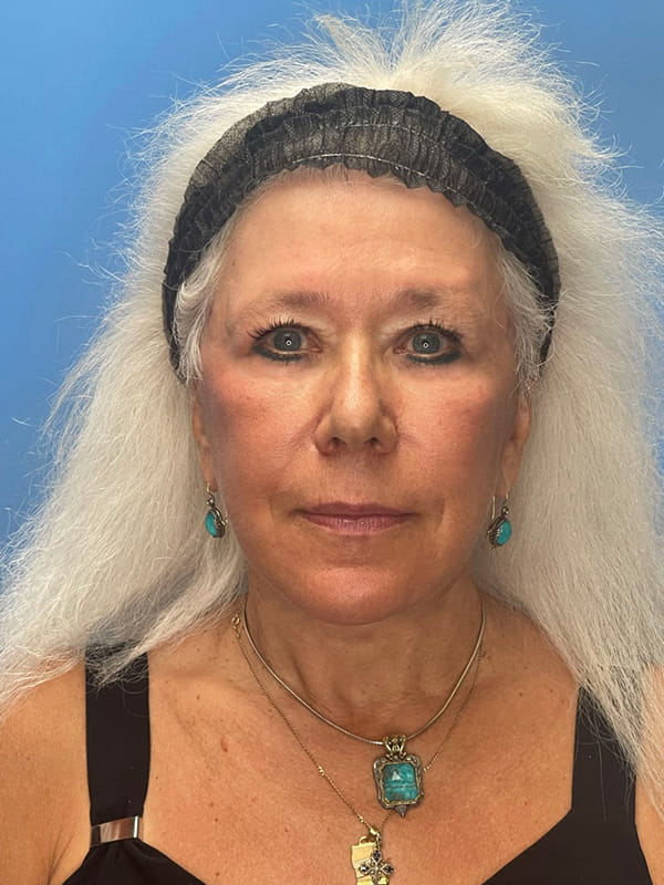 Lower Facelift<br>(SMAS Lift) Before & After Image