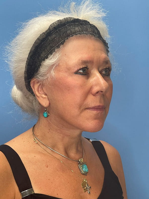 Lower Facelift<br>(SMAS Lift) Before & After Image