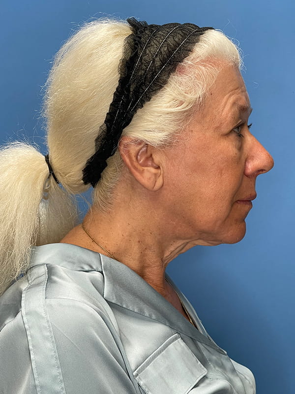 Lower Facelift (SMAS Lift) Before and After | OCSS