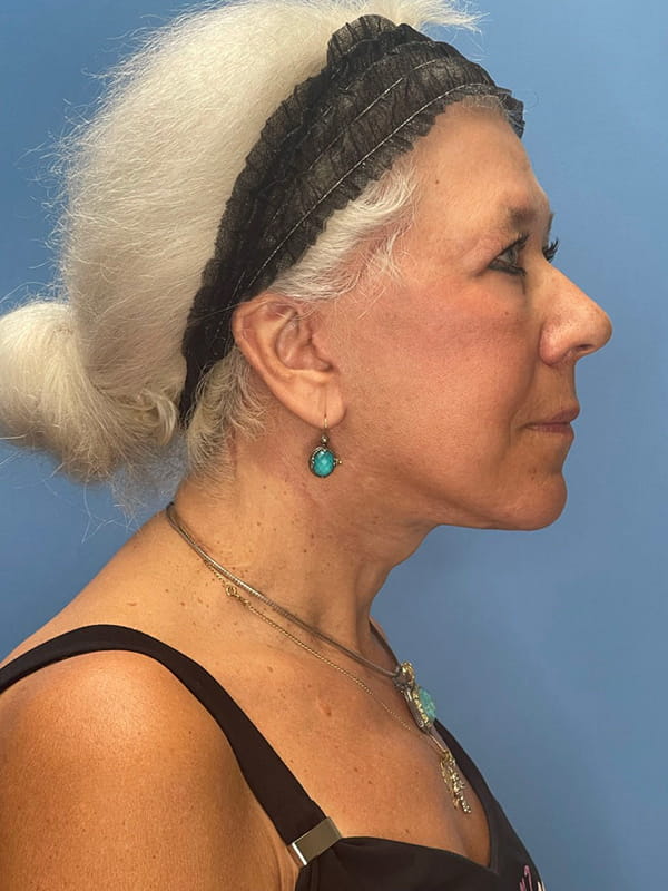 Lower Facelift (SMAS Lift) Before and After | OCSS