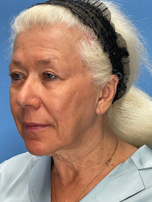 Lower Facelift<br>(SMAS Lift) Before & After Image