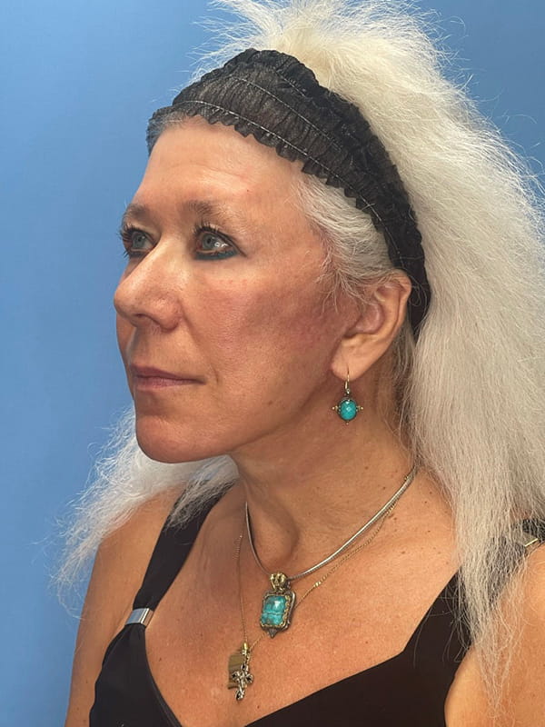 Lower Facelift<br>(SMAS Lift) Before & After Image