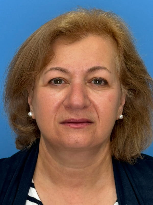 Lower Facelift<br>(SMAS Lift) Before & After Image