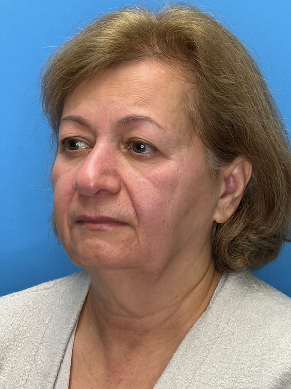 Lower Facelift<br>(SMAS Lift) Before & After Image