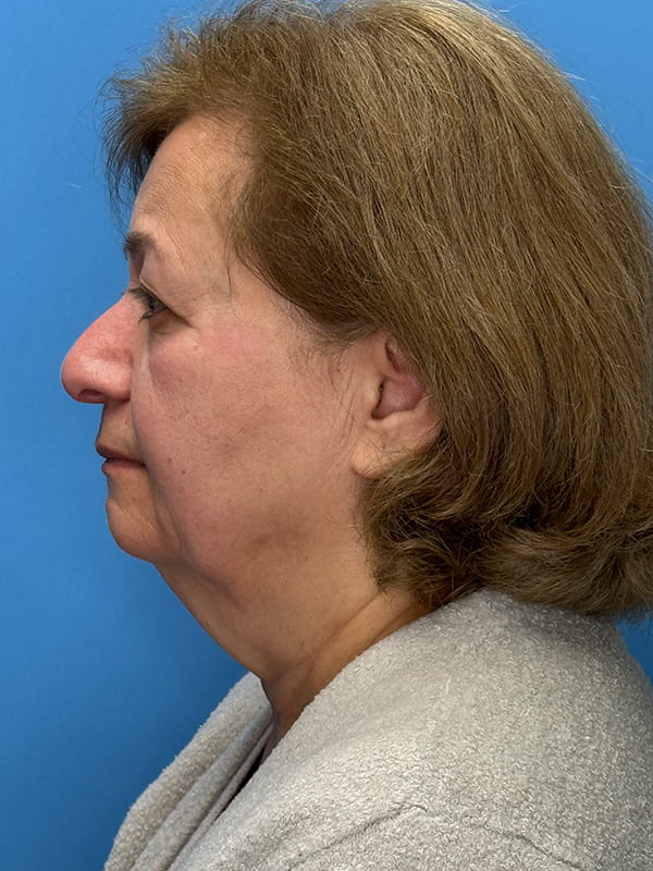 Lower Facelift<br>(SMAS Lift) Before & After Image