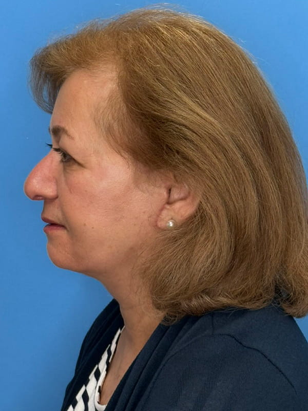 Lower Facelift<br>(SMAS Lift) Before & After Image