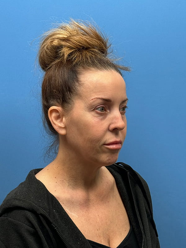 Lower Facelift<br>(SMAS Lift) Before & After Image