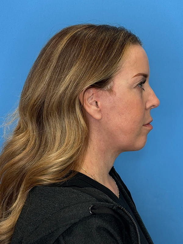 Lower Facelift<br>(SMAS Lift) Before & After Image