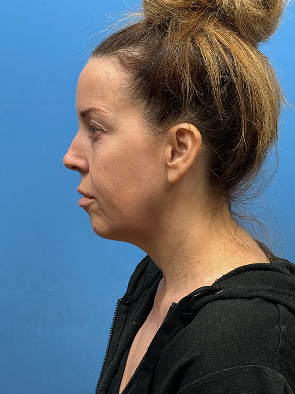 Lower Facelift<br>(SMAS Lift) Before & After Image