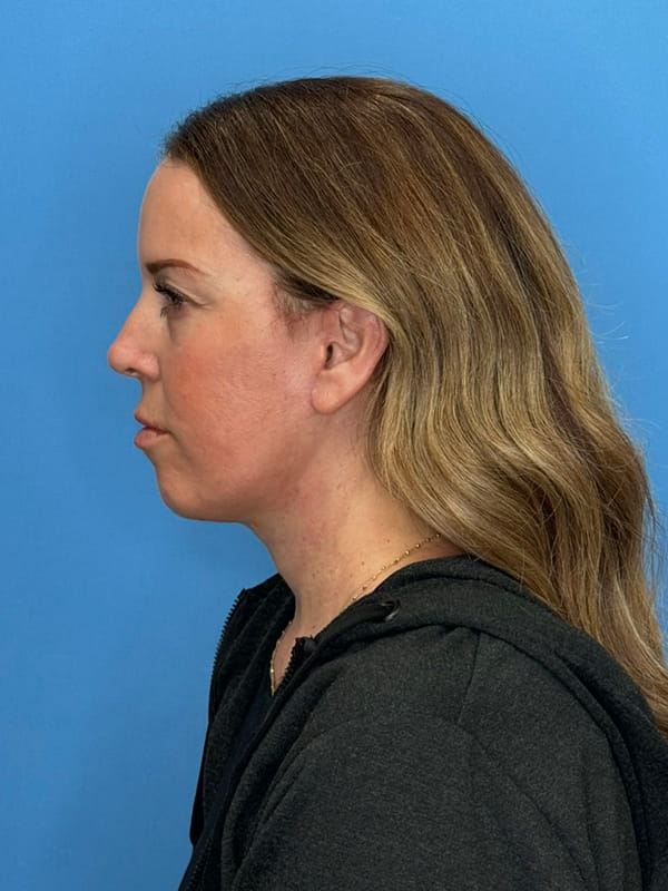 Lower Facelift<br>(SMAS Lift) Before & After Image