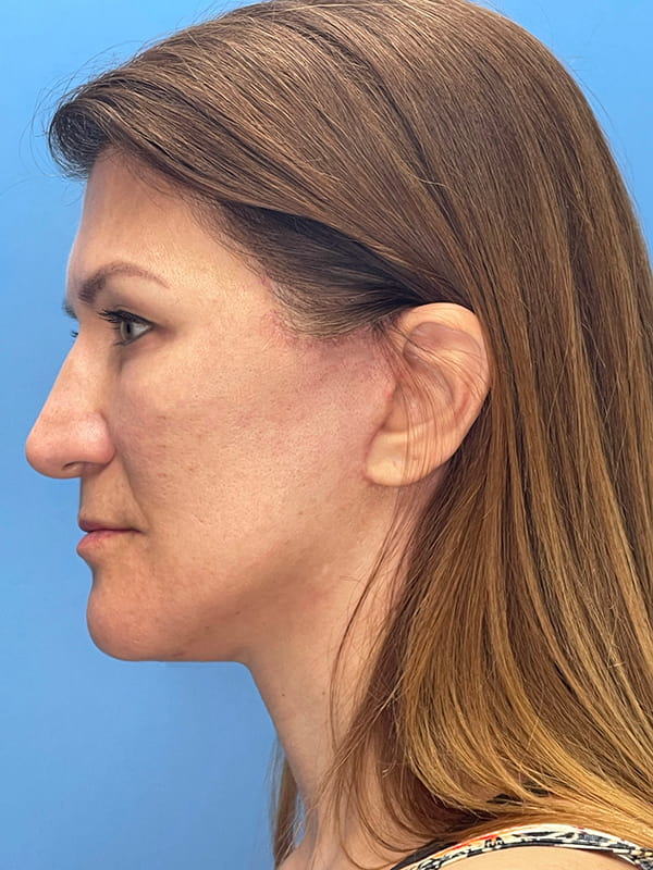 Lower Facelift<br>(SMAS Lift) Before & After Image