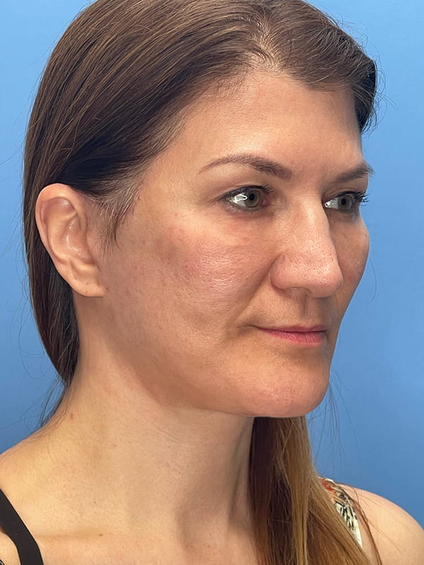 Lower Facelift<br>(SMAS Lift) Before & After Image