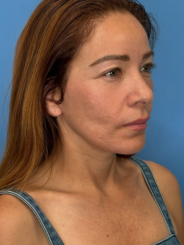 Lower Facelift (SMAS Lift) Before and After | OCSS