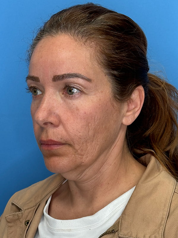 Lower Facelift<br>(SMAS Lift) Before & After Image