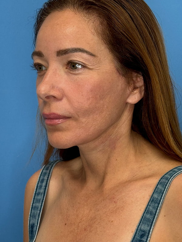 Lower Facelift<br>(SMAS Lift) Before & After Image