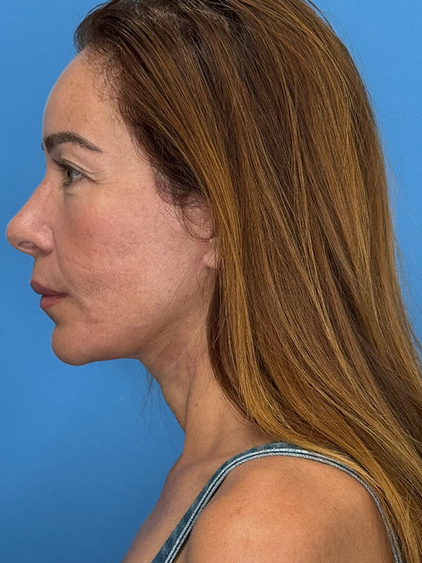 Lower Facelift<br>(SMAS Lift) Before & After Image