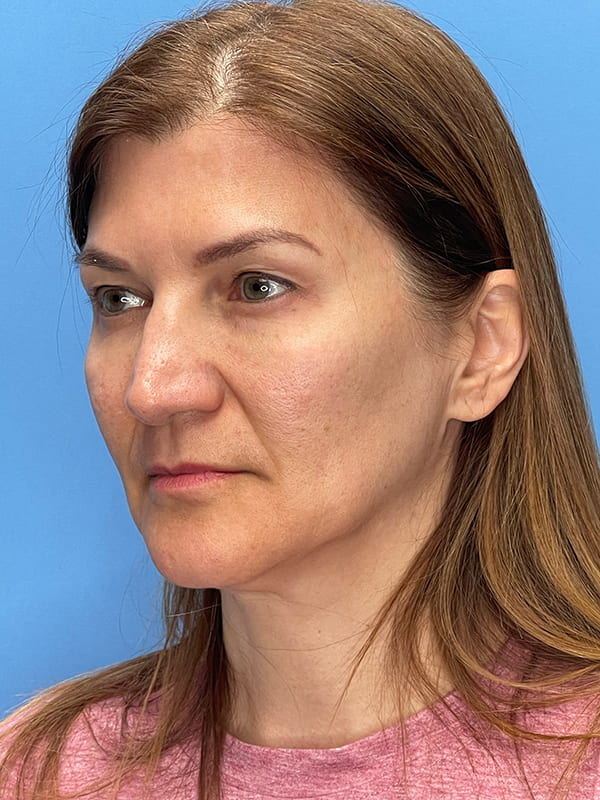 Lower Facelift<br>(SMAS Lift) Before & After Image