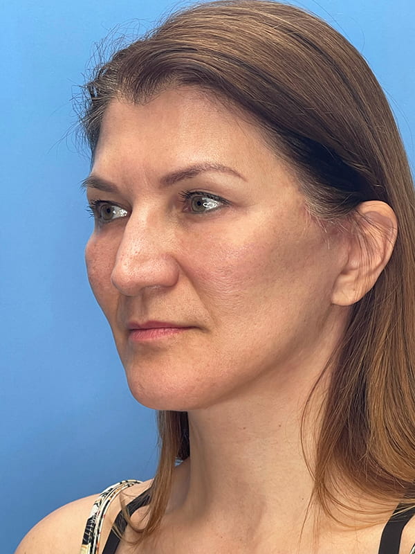 Lower Facelift<br>(SMAS Lift) Before & After Image