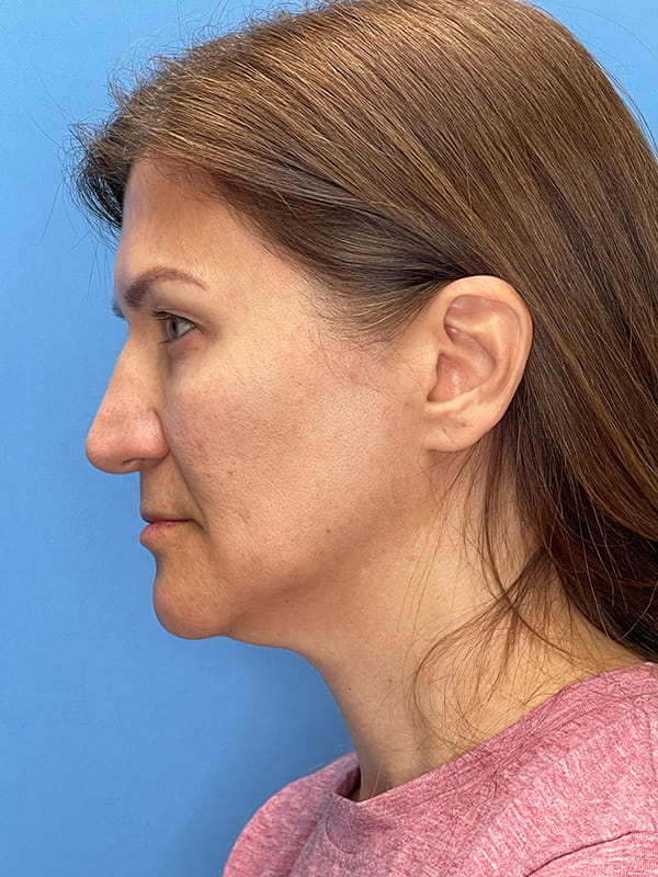 Lower Facelift<br>(SMAS Lift) Before & After Image